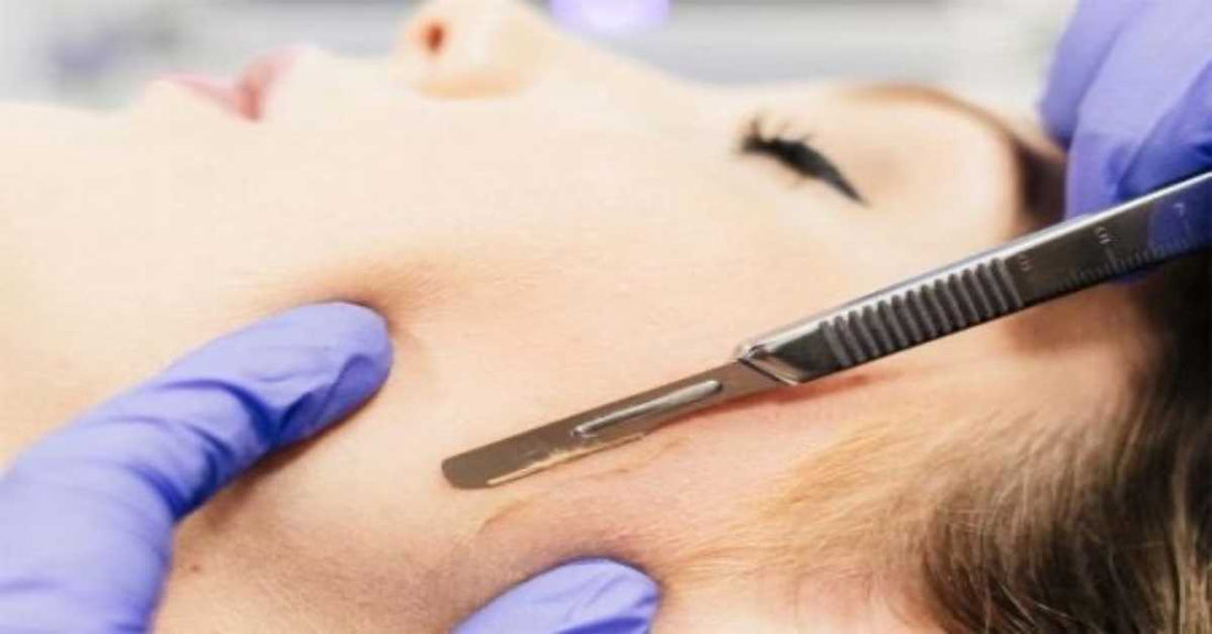 All about Dermaplaning!