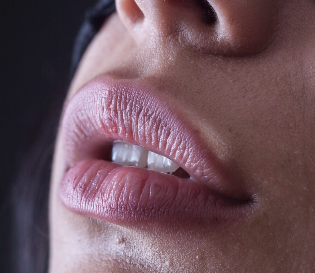 How Long Does Swelling Last After Lip Filler? – Here’s How to Soothe & Manage It