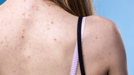 How to Prevent & Overcome Back Acne